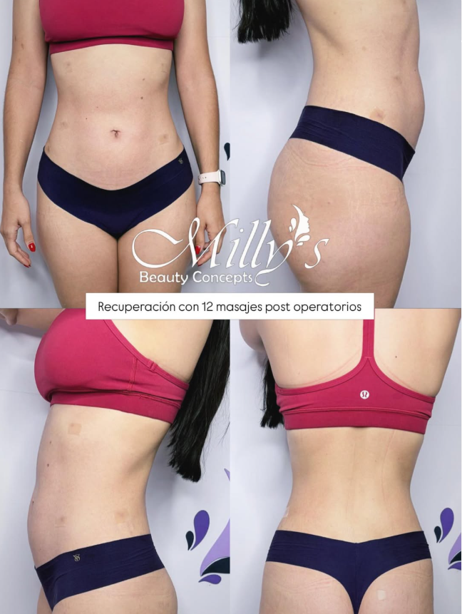Before and after lymphatic drainage massage results following liposuction and BBL at Milly's Beauty Concepts in Las Vegas