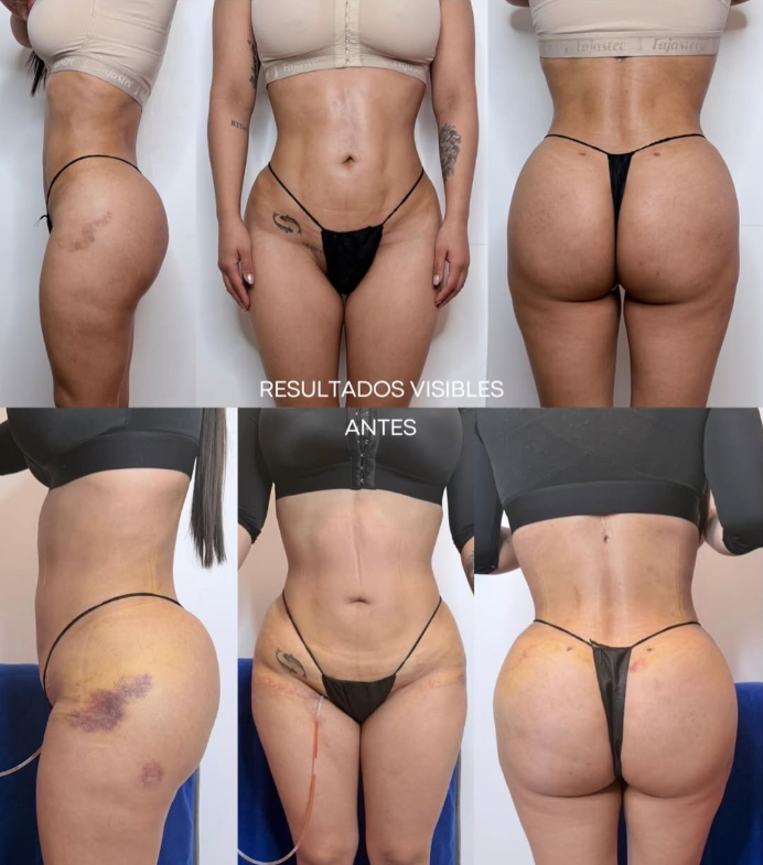 Before and after lymphatic drainage massage results following liposuction and BBL at Milly's Beauty Concepts in Las Vegas